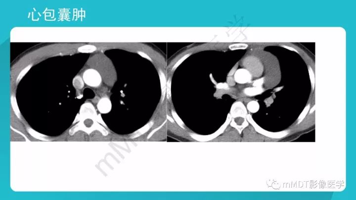 【PPT】纵隔肿瘤影像诊断（全）