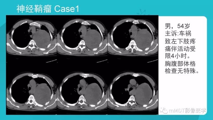 【PPT】纵隔肿瘤影像诊断（全）