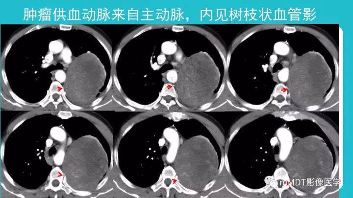 【PPT】纵隔肿瘤影像诊断（全）