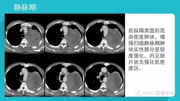 【PPT】纵隔肿瘤影像诊断（全）