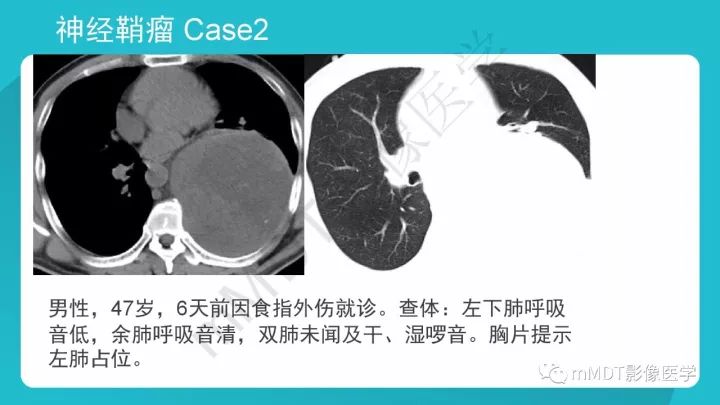 【PPT】纵隔肿瘤影像诊断（全）
