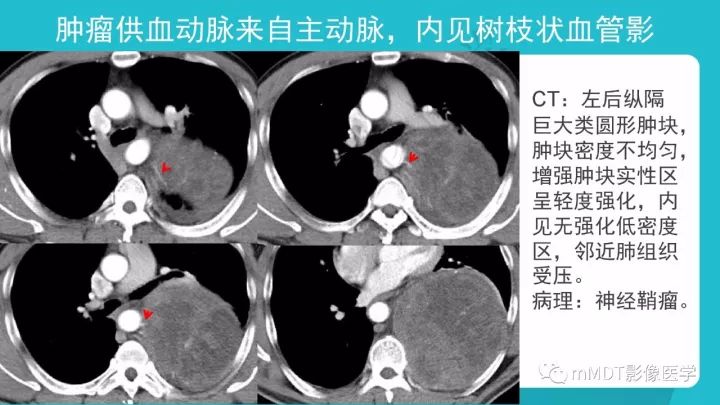 【PPT】纵隔肿瘤影像诊断（全）