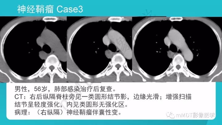 【PPT】纵隔肿瘤影像诊断（全）