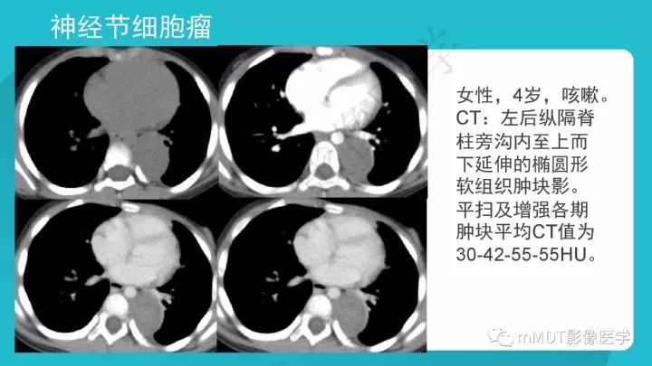 【PPT】纵隔肿瘤影像诊断（全）