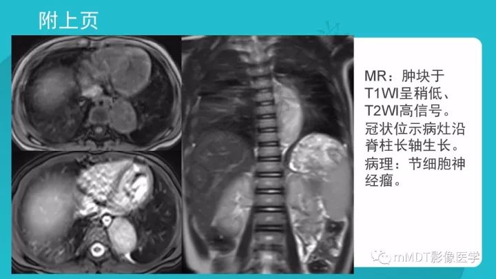 【PPT】纵隔肿瘤影像诊断（全）