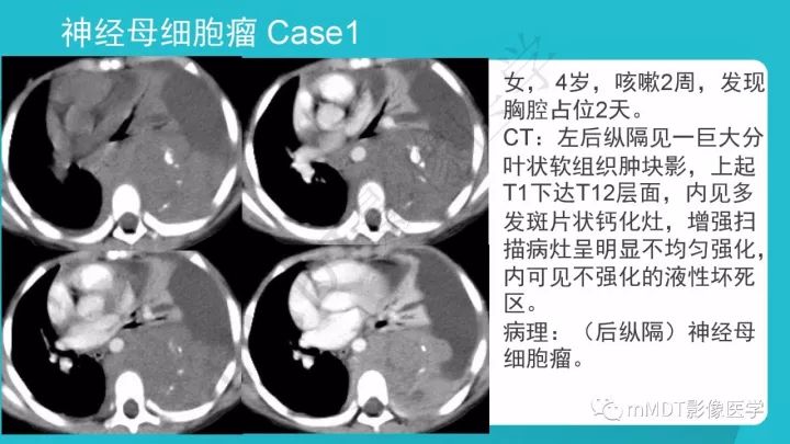 【PPT】纵隔肿瘤影像诊断（全）