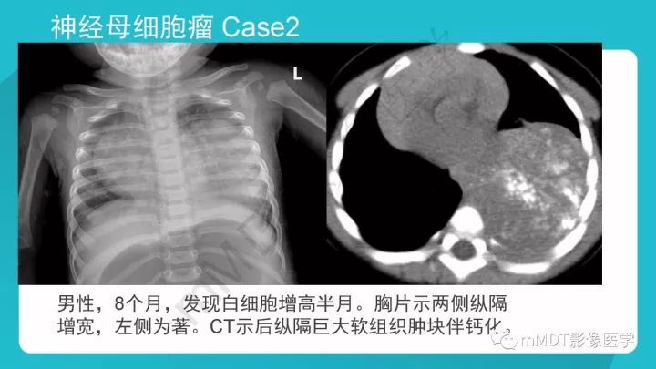 【PPT】纵隔肿瘤影像诊断（全）