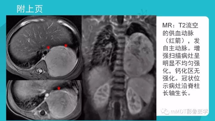 【PPT】纵隔肿瘤影像诊断（全）