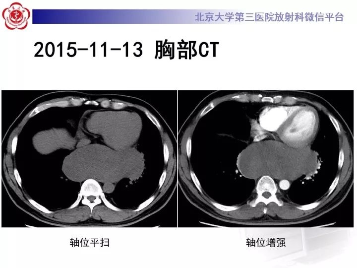 【病例】纵隔滑膜肉瘤1例CT影像表现