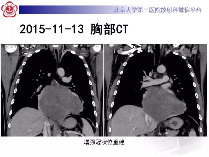 【病例】纵隔滑膜肉瘤1例CT影像表现