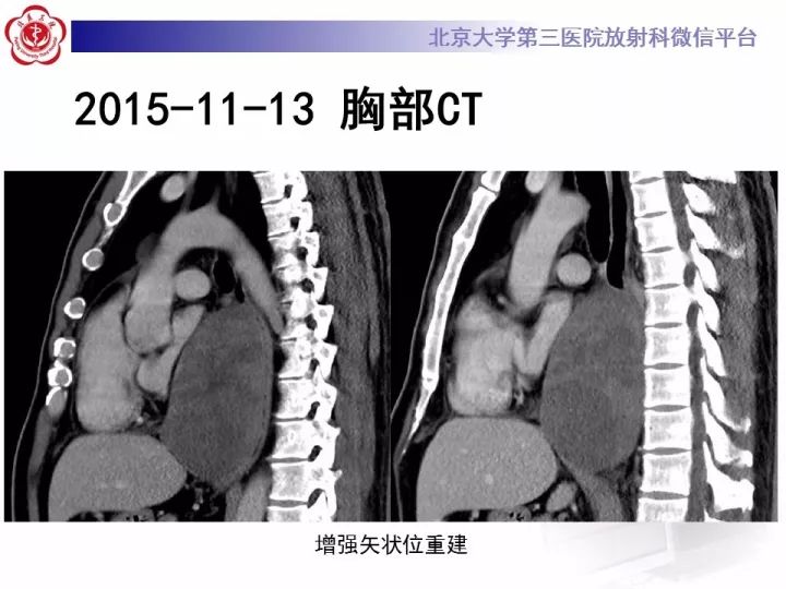 【病例】纵隔滑膜肉瘤1例CT影像表现