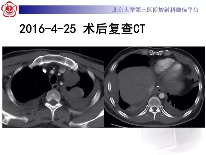 【病例】纵隔滑膜肉瘤1例CT影像表现