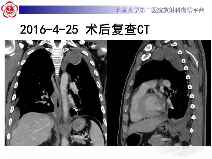【病例】纵隔滑膜肉瘤1例CT影像表现