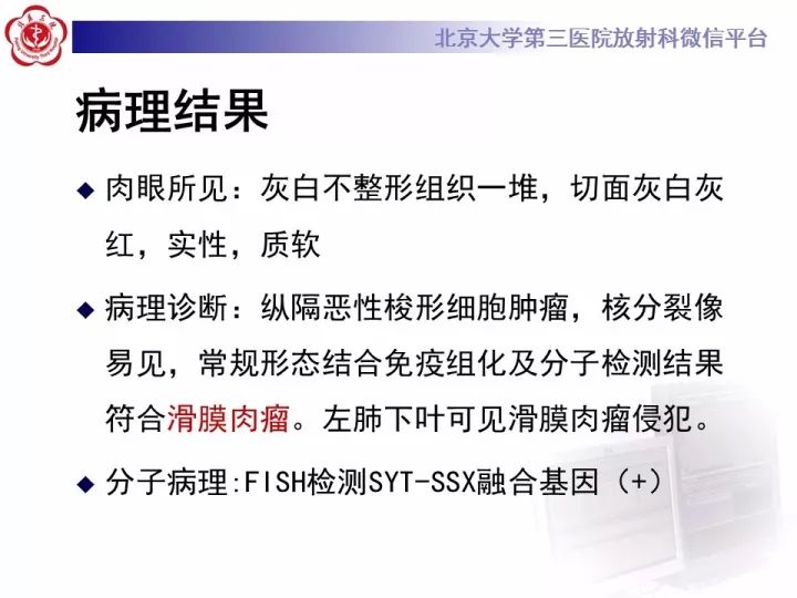 【病例】纵隔滑膜肉瘤1例CT影像表现