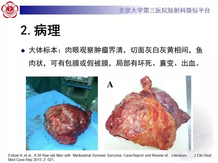 【病例】纵隔滑膜肉瘤1例CT影像表现