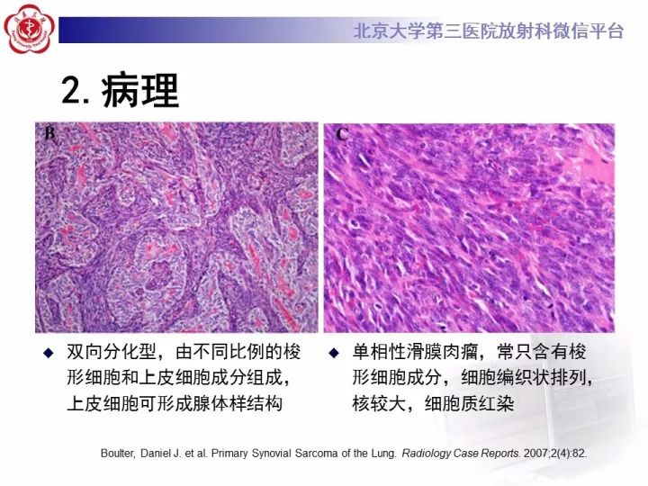 【病例】纵隔滑膜肉瘤1例CT影像表现
