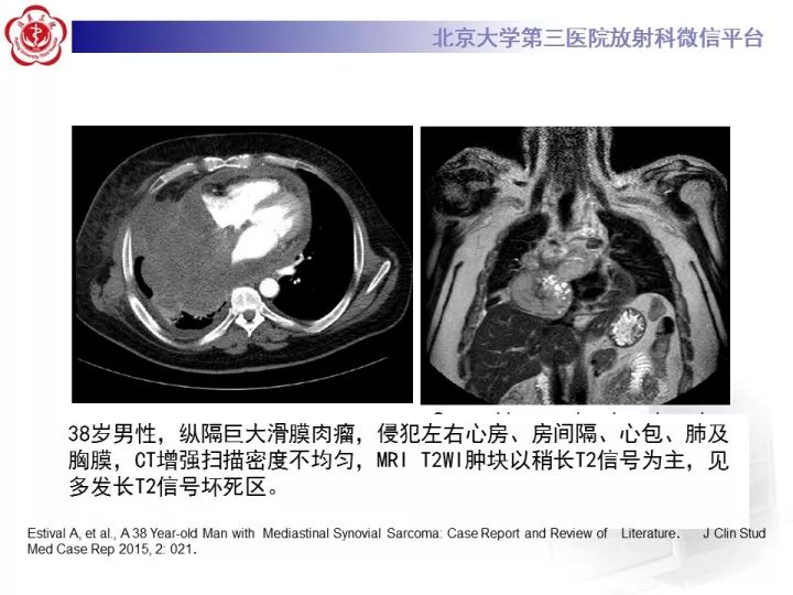 【病例】纵隔滑膜肉瘤1例CT影像表现