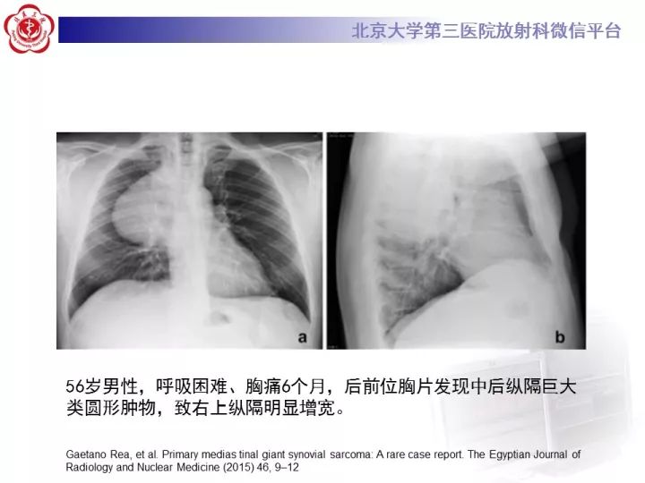 【病例】纵隔滑膜肉瘤1例CT影像表现