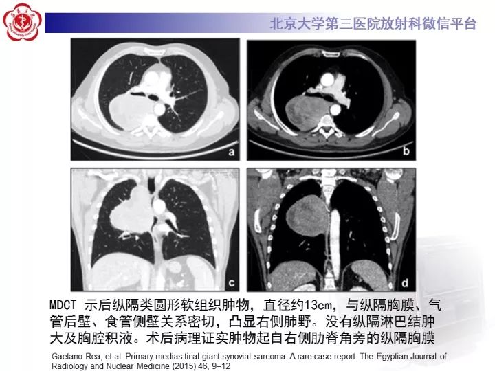 【病例】纵隔滑膜肉瘤1例CT影像表现