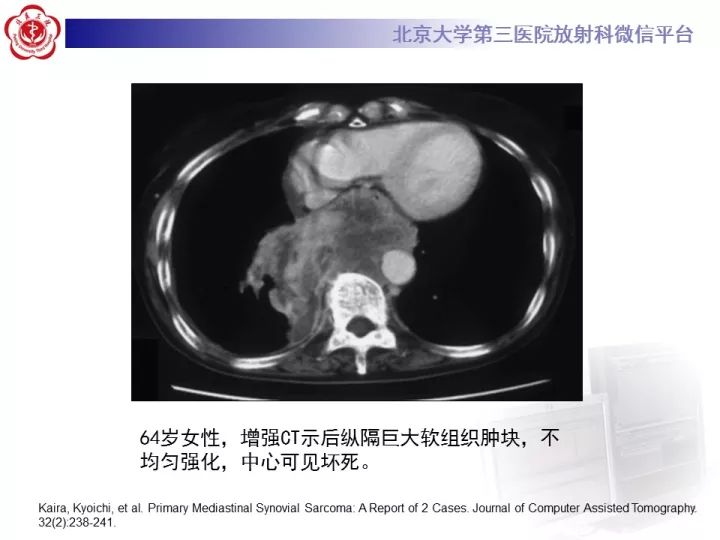 【病例】纵隔滑膜肉瘤1例CT影像表现
