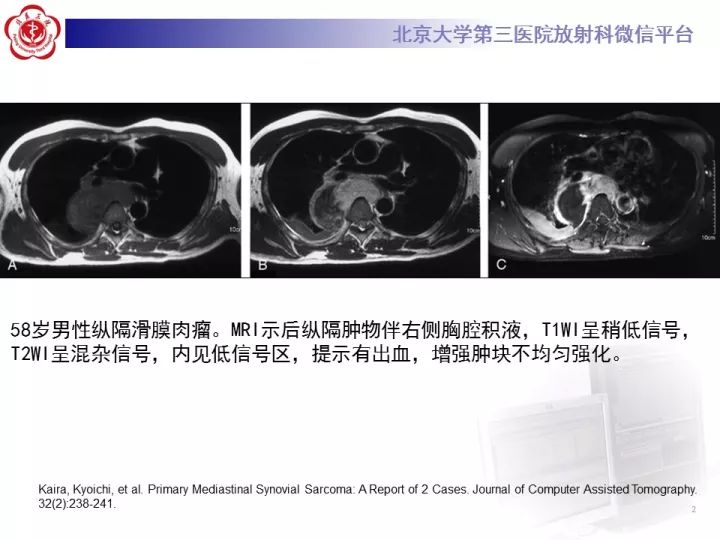 【病例】纵隔滑膜肉瘤1例CT影像表现