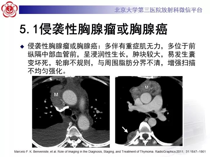 【病例】纵隔滑膜肉瘤1例CT影像表现