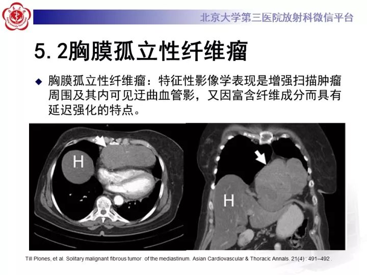 【病例】纵隔滑膜肉瘤1例CT影像表现