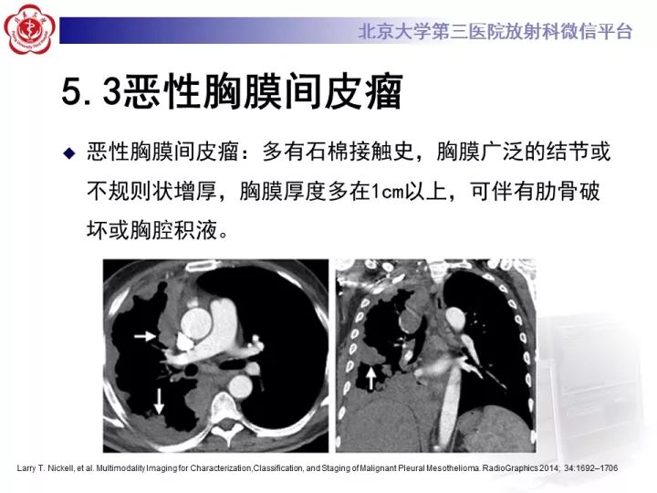 【病例】纵隔滑膜肉瘤1例CT影像表现