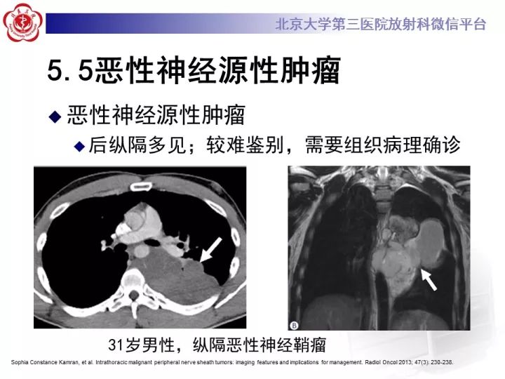 【病例】纵隔滑膜肉瘤1例CT影像表现