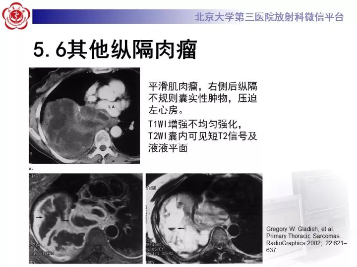 【病例】纵隔滑膜肉瘤1例CT影像表现