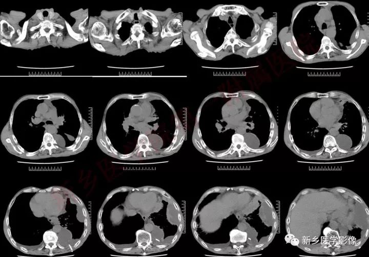 【病例】小细胞肺癌1例CT影像表现 【病例】小细胞肺癌1例CT影像表现