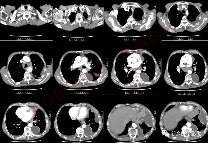 【病例】小细胞肺癌1例CT影像表现 【病例】小细胞肺癌1例CT影像表现