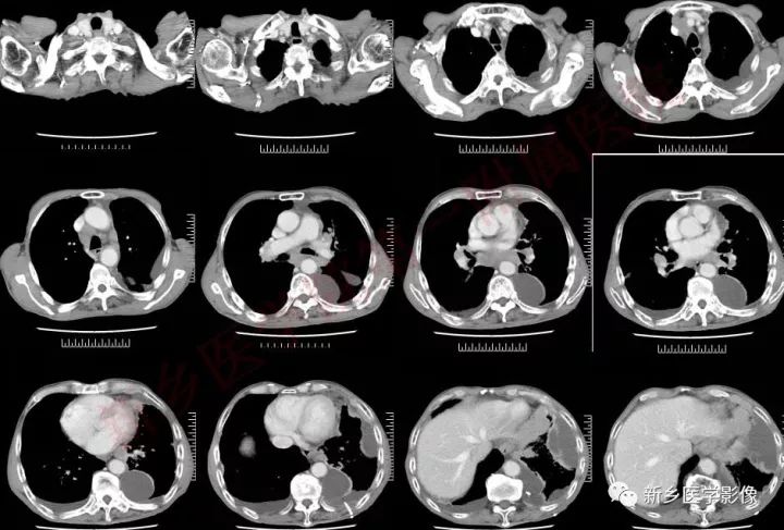 【病例】小细胞肺癌1例CT影像表现 【病例】小细胞肺癌1例CT影像表现