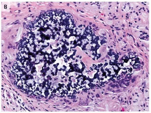 【病例】肺异物性肉芽肿1例CT影像表现