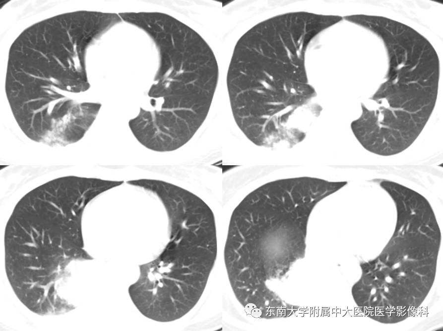 【病例】肺隔离症1例CT影像表现