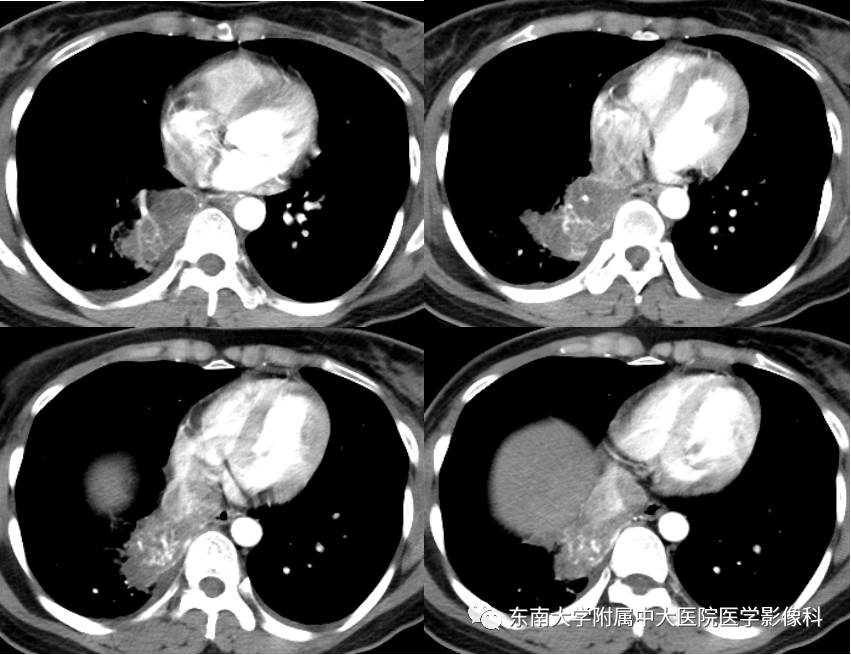 【病例】肺隔离症1例CT影像表现