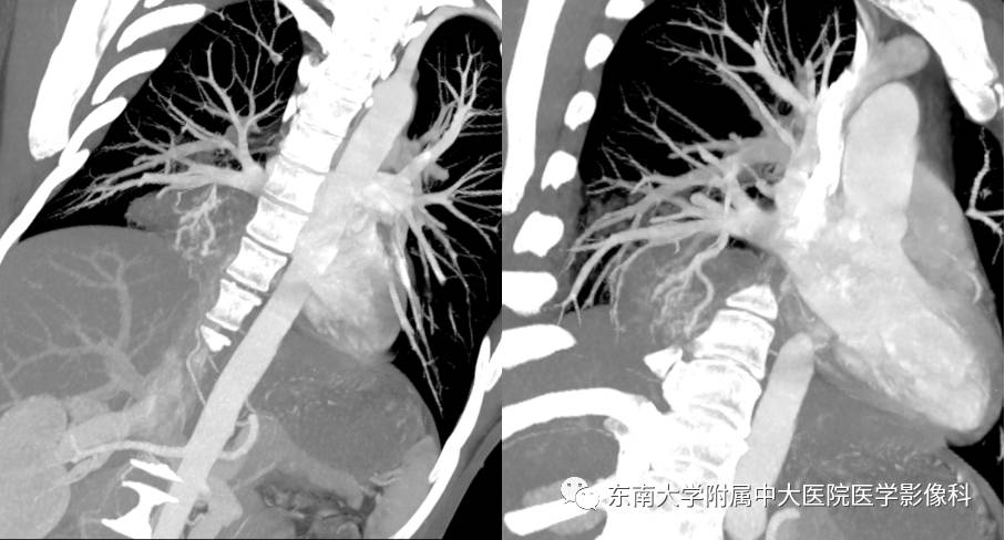 【病例】肺隔离症1例CT影像表现