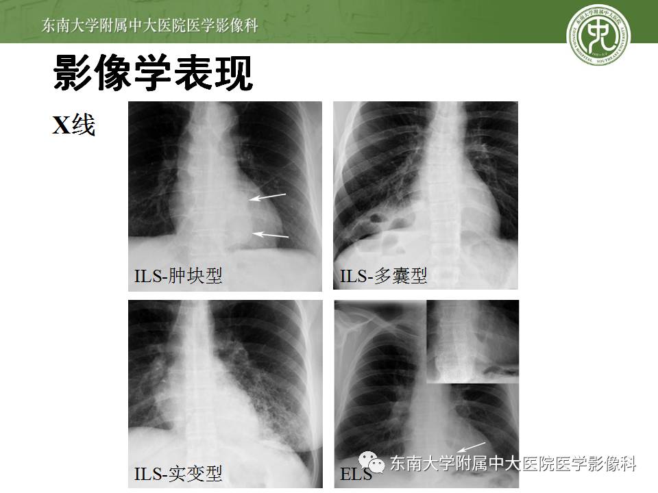 【病例】肺隔离症1例CT影像表现