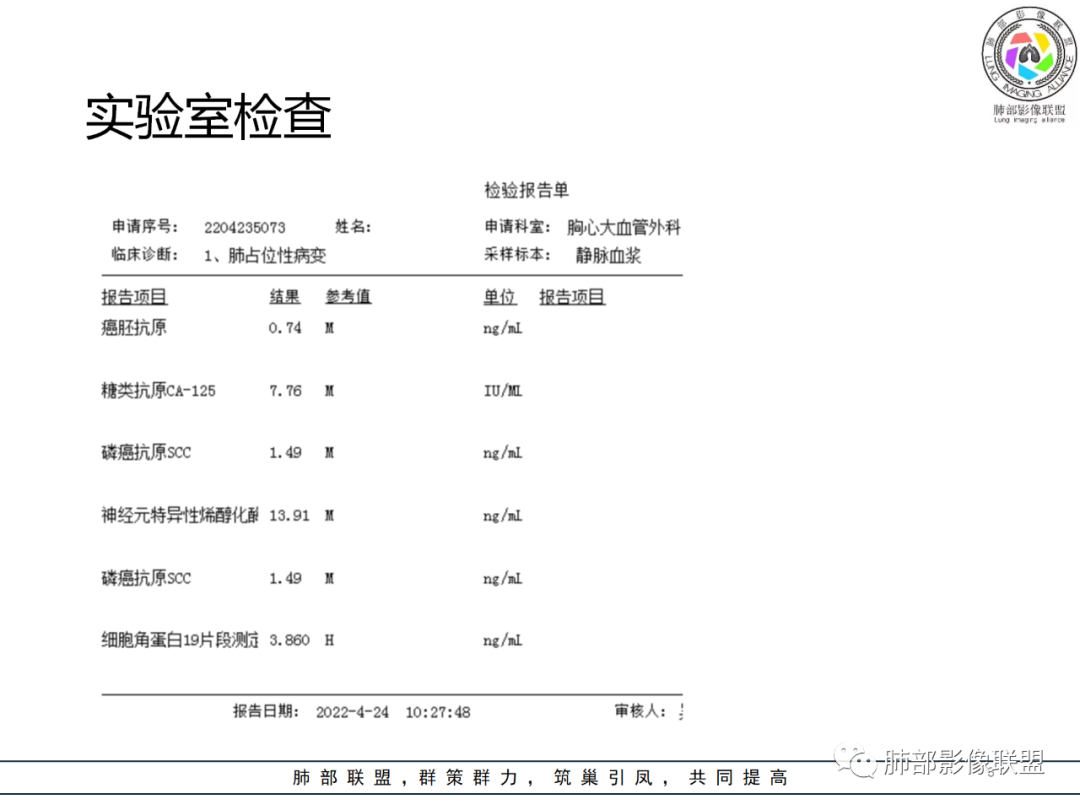 【病例】硬化性肺泡细胞瘤PSP一例CT-3 【病例】硬化性肺泡细胞瘤PSP一例CT-3