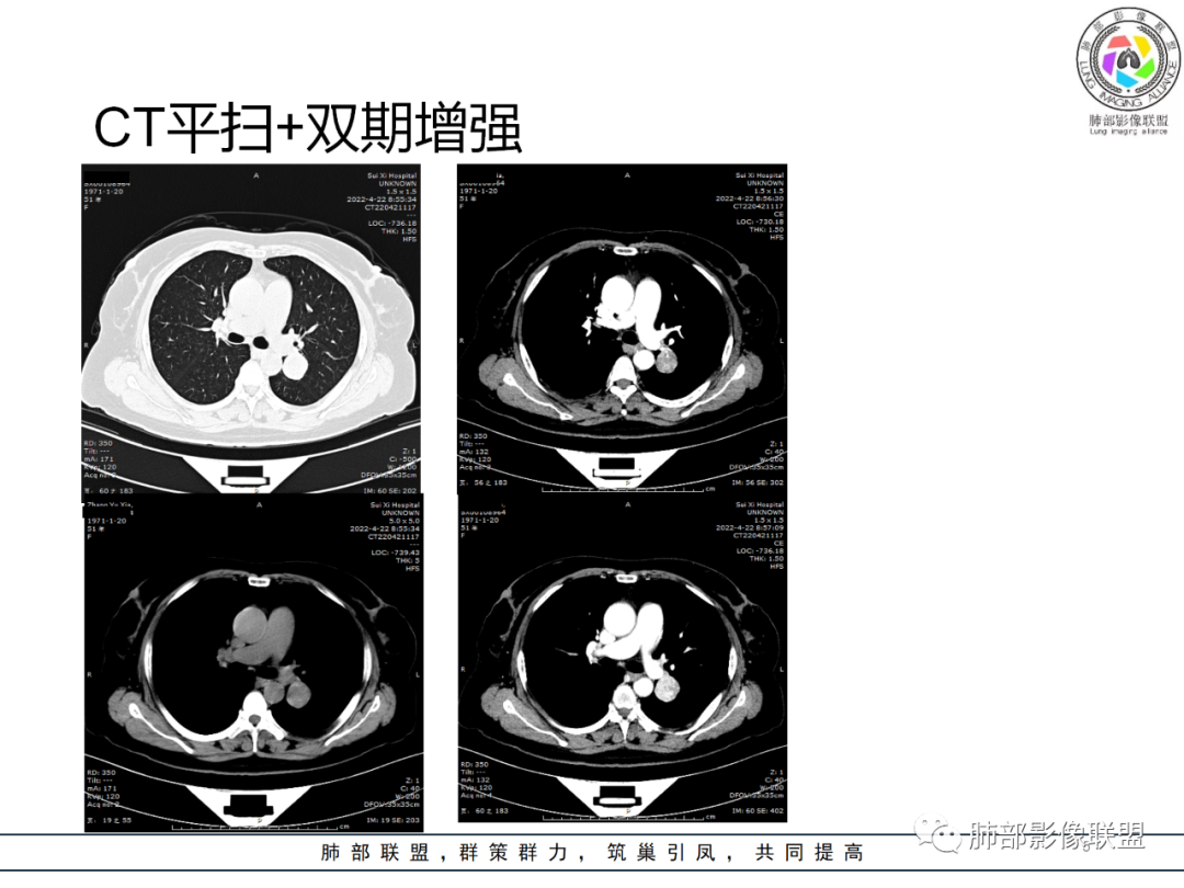 【病例】硬化性肺泡细胞瘤PSP一例CT-5 【病例】硬化性肺泡细胞瘤PSP一例CT-5