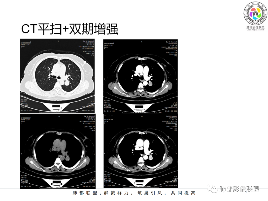 【病例】硬化性肺泡细胞瘤PSP一例CT-4 【病例】硬化性肺泡细胞瘤PSP一例CT-4