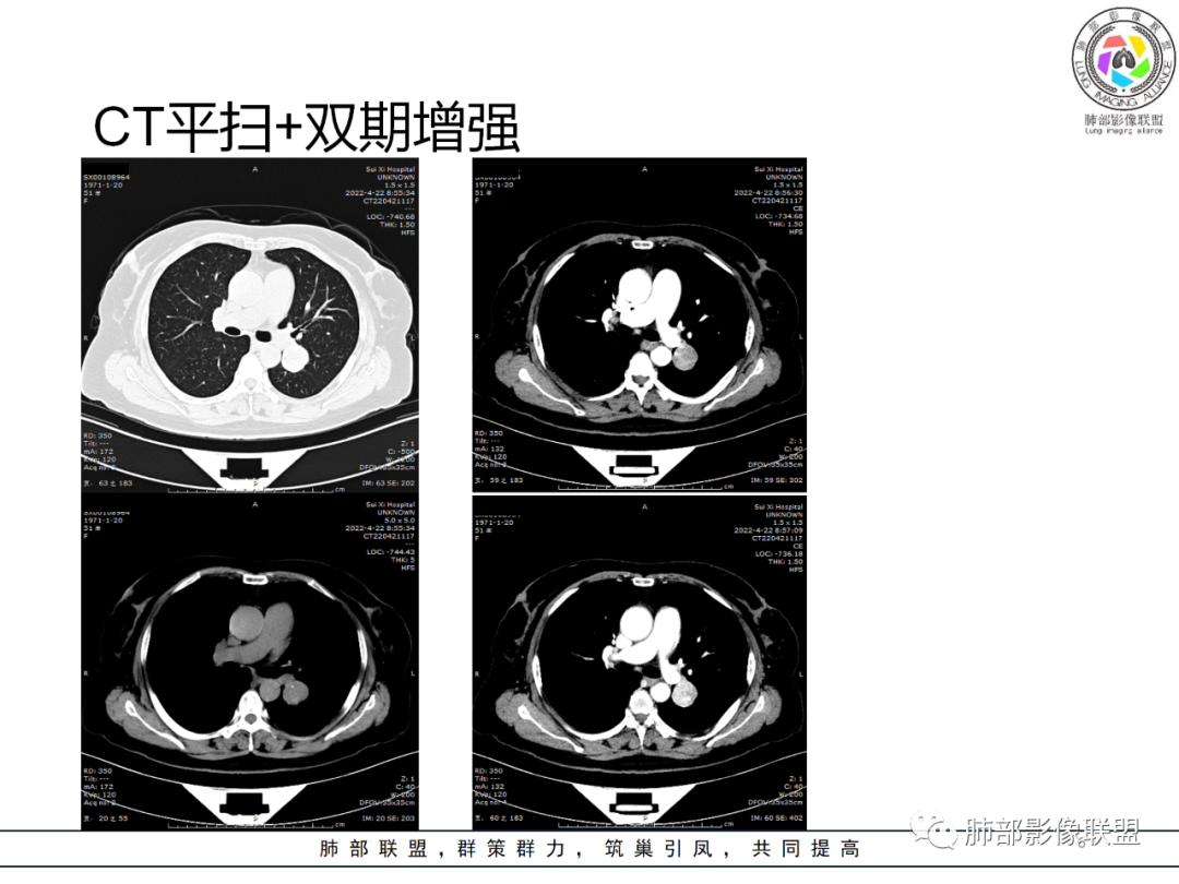 【病例】硬化性肺泡细胞瘤PSP一例CT-6 【病例】硬化性肺泡细胞瘤PSP一例CT-6
