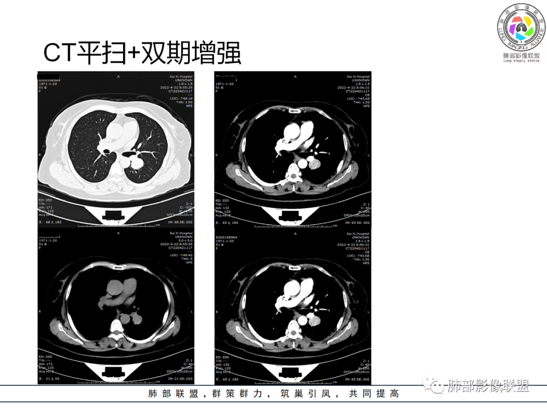 【病例】硬化性肺泡细胞瘤PSP一例CT-7 【病例】硬化性肺泡细胞瘤PSP一例CT-7