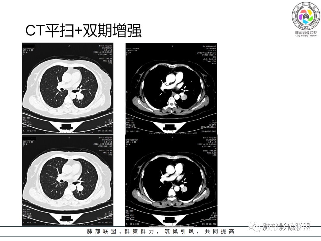 【病例】硬化性肺泡细胞瘤PSP一例CT-8 【病例】硬化性肺泡细胞瘤PSP一例CT-8