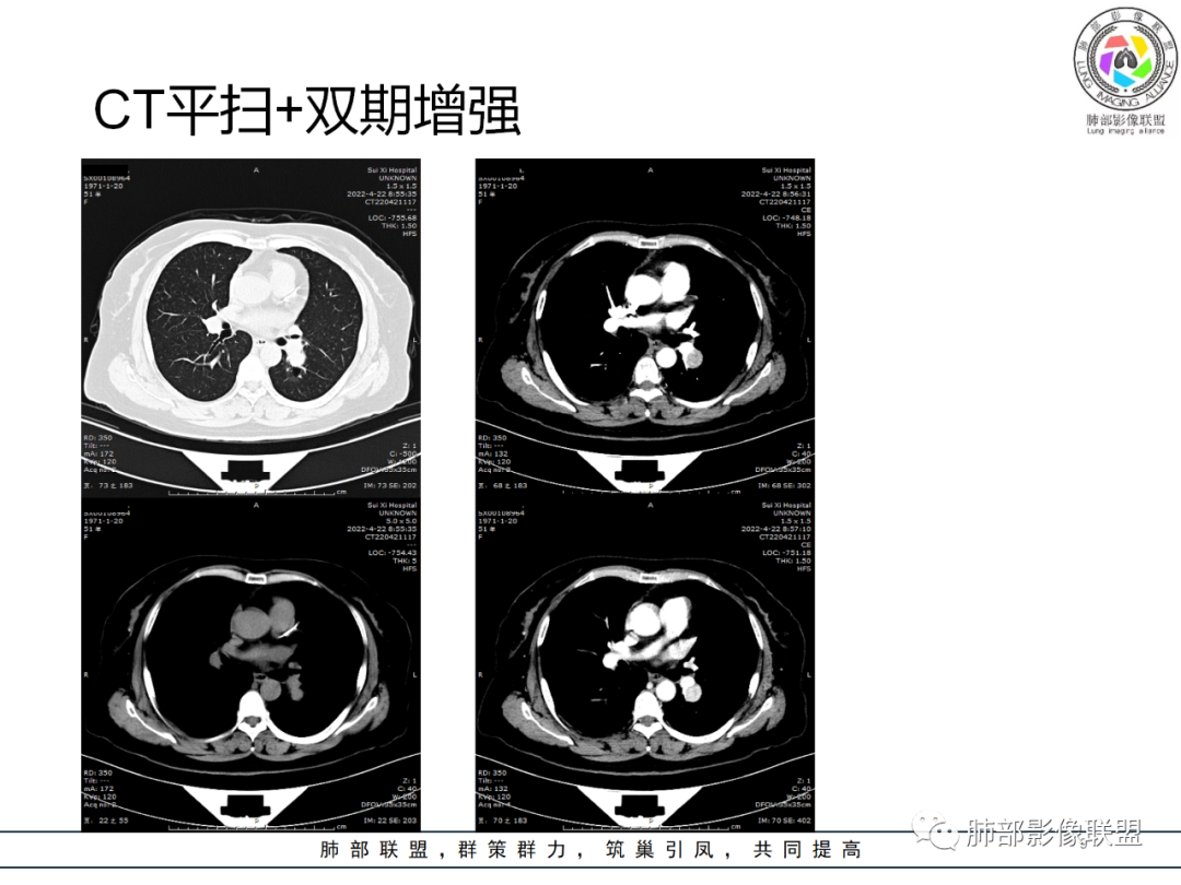 【病例】硬化性肺泡细胞瘤PSP一例CT-9 【病例】硬化性肺泡细胞瘤PSP一例CT-9