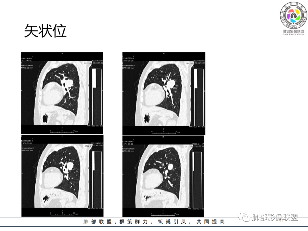 【病例】硬化性肺泡细胞瘤PSP一例CT-11 【病例】硬化性肺泡细胞瘤PSP一例CT-11