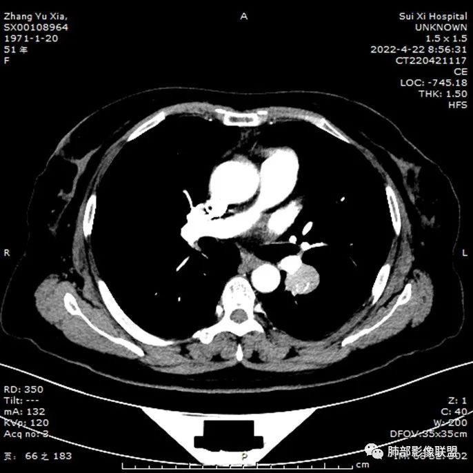 【病例】硬化性肺泡细胞瘤PSP一例CT-13 【病例】硬化性肺泡细胞瘤PSP一例CT-13
