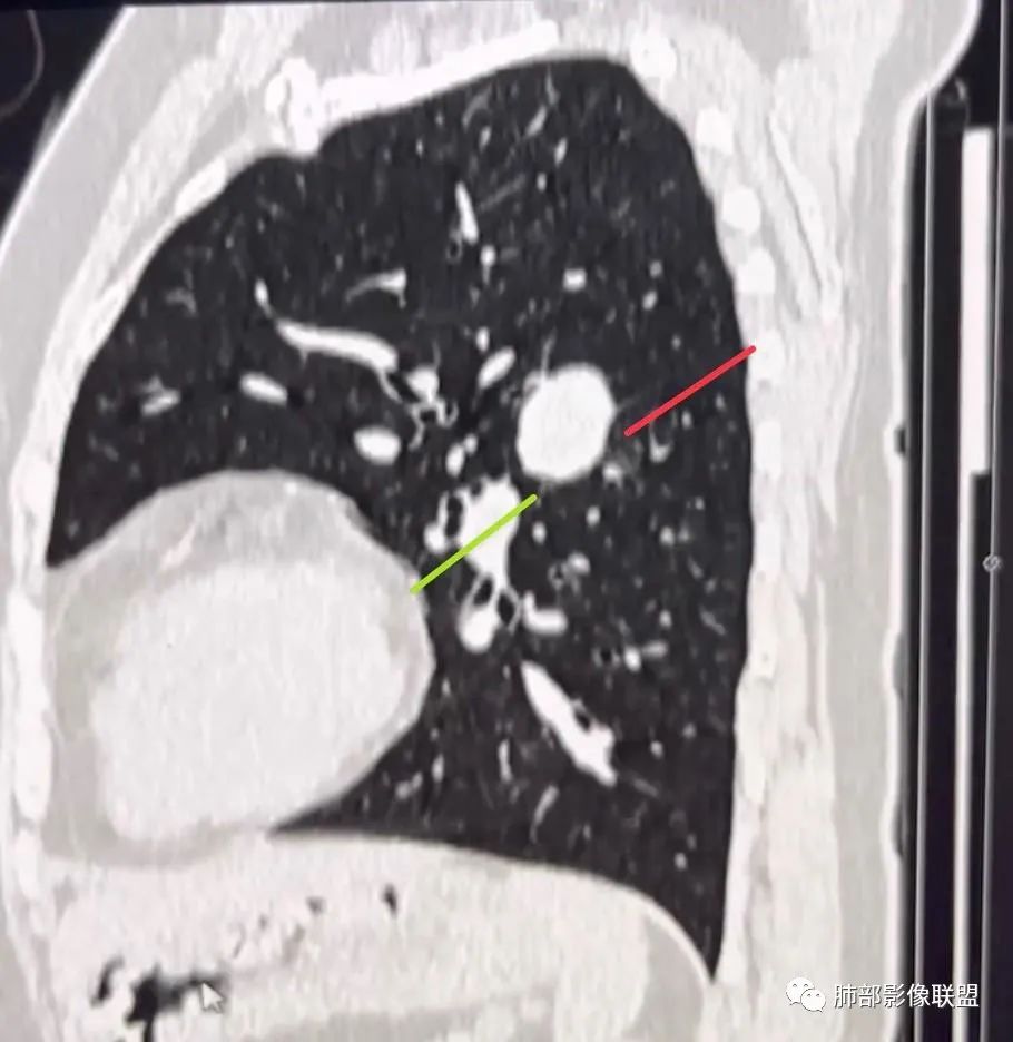 【病例】硬化性肺泡细胞瘤PSP一例CT-14 【病例】硬化性肺泡细胞瘤PSP一例CT-14
