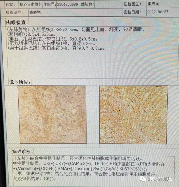 【病例】硬化性肺泡细胞瘤PSP一例CT-15 【病例】硬化性肺泡细胞瘤PSP一例CT-15