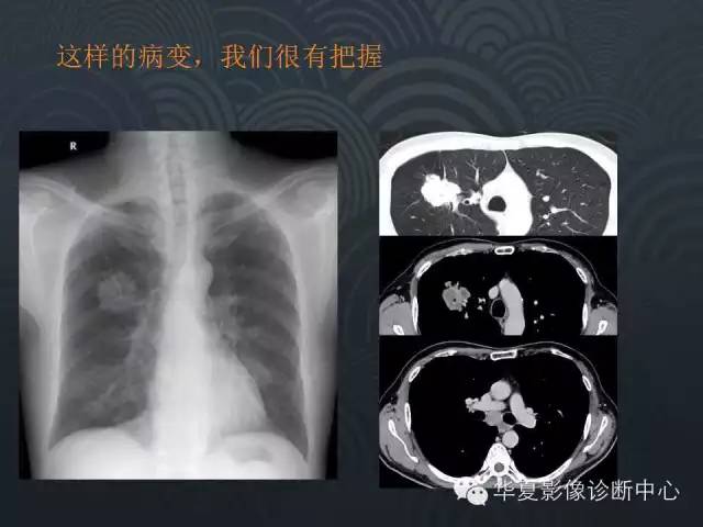 【PPT】小肺癌的影像表现及鉴别诊断